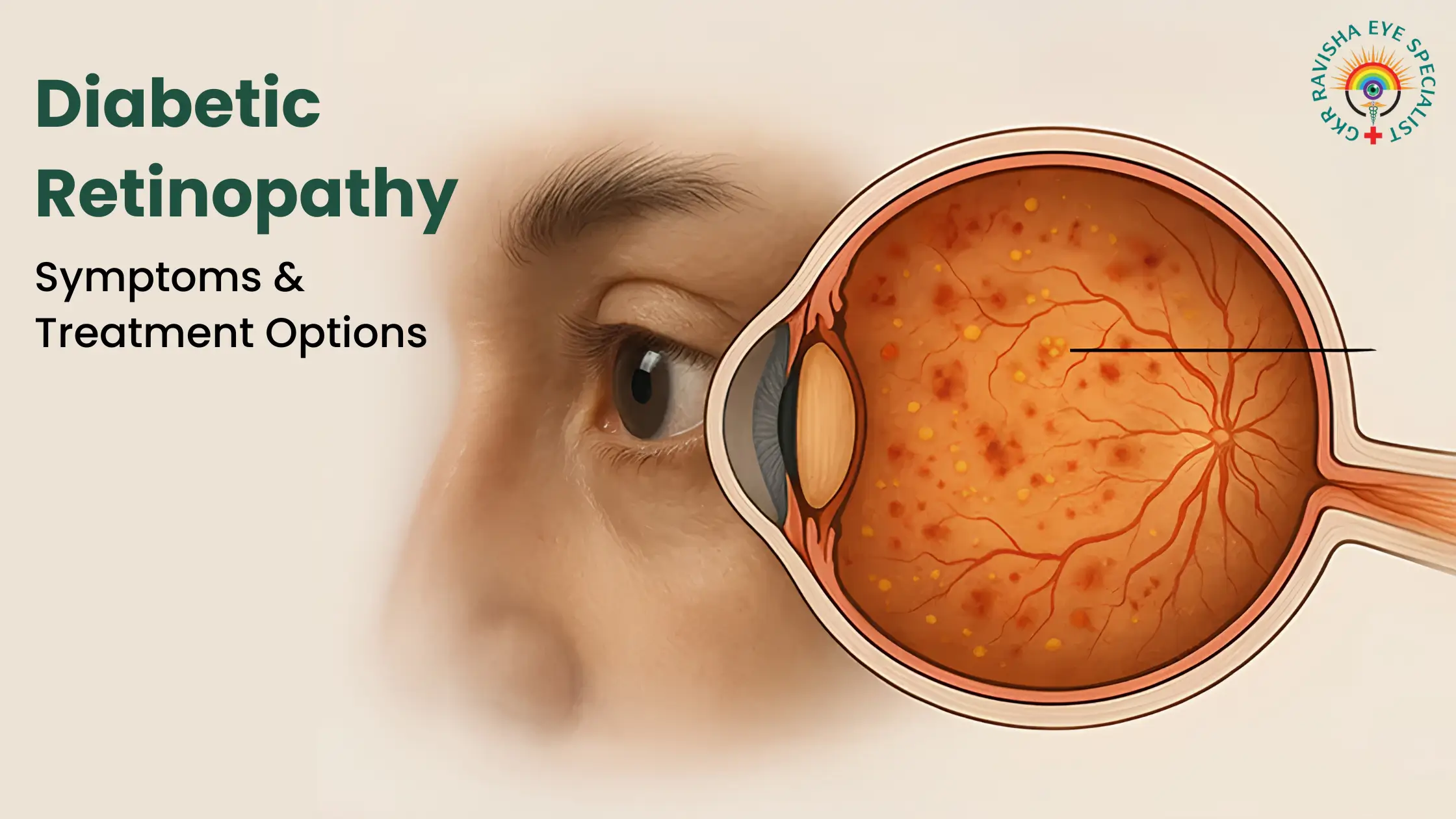 Diabetic Retinopathy – Symptoms & Treatment Options